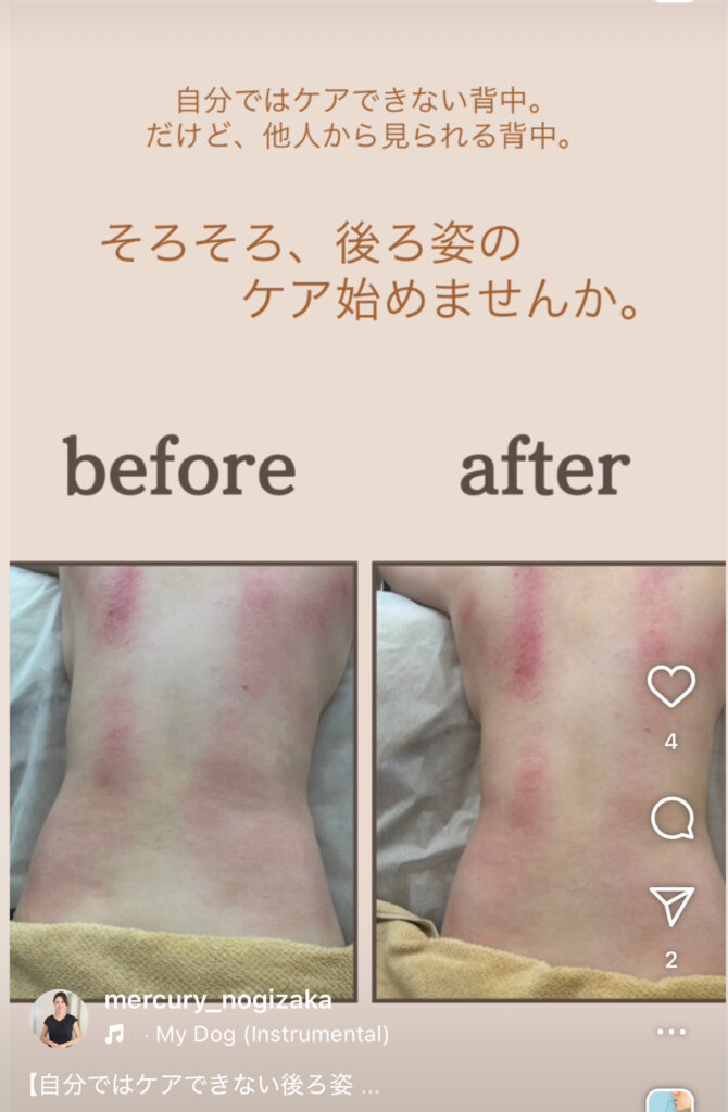夏に向けて、背中の痩身ケアが急増中☆