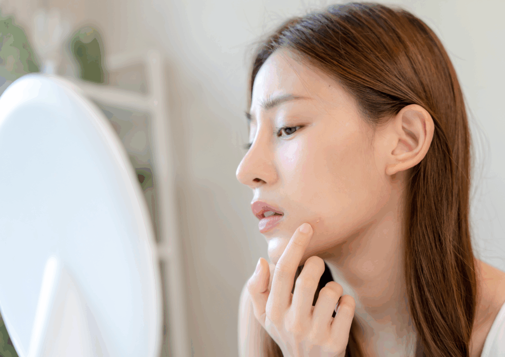 糖分オーバーでニキビ!? 糖分オーバーでニキビ!?